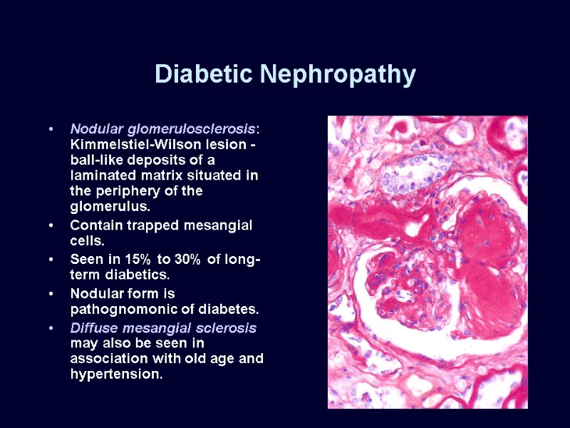 Diabetic Nephropathy Nodular glomerulosclerosis: Kimmelstiel-Wilson lesion -ball-like deposits of a laminated matrix situated in
